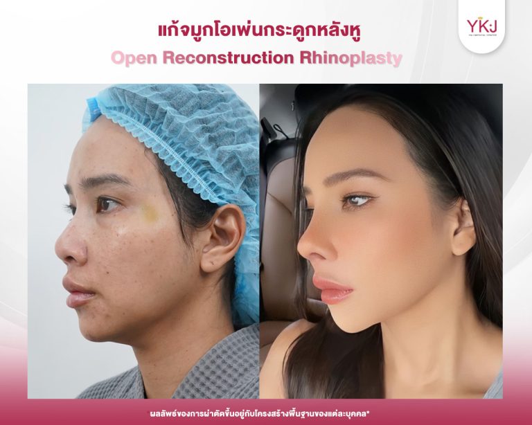 รีวิวแก้จมูก , รีวิวเสริมจมูกโอเพ่น , กระดูกอ่อนหลังหู