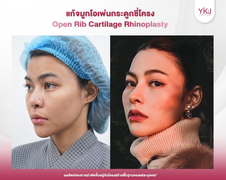 รีวิวแก้จมูก , รีวิวเสริมจมูกโอเพ่น , กระดูกซี่โครง