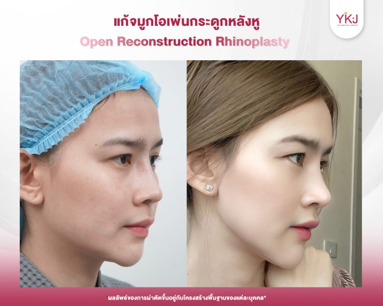 รีวิวแก้จมูก , รีวิวเสริมจมูกโอเพ่น , กระดูกอ่อนหลังหู