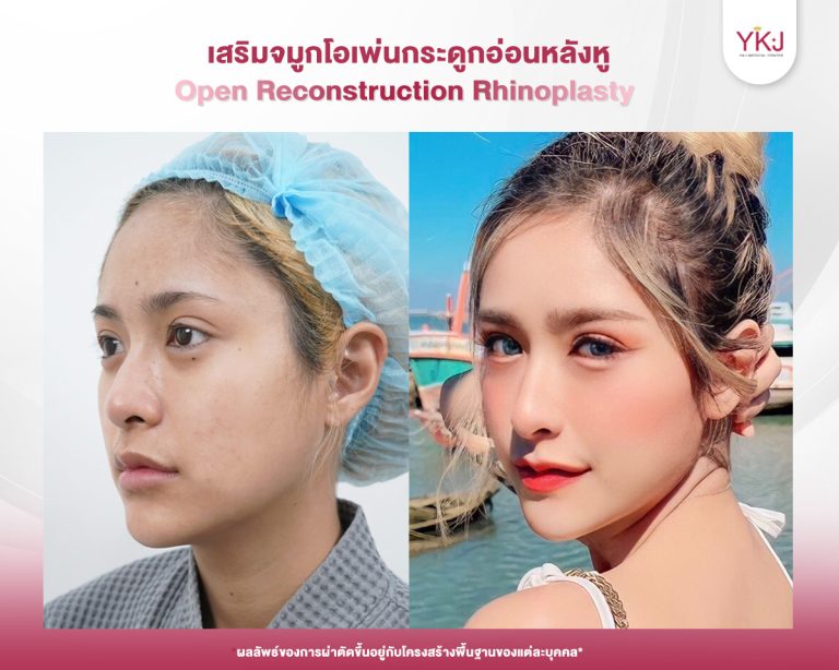 รีวิวแก้จมูก , รีวิวเสริมจมูกโอเพ่น , กระดูกอ่อนหลังหู