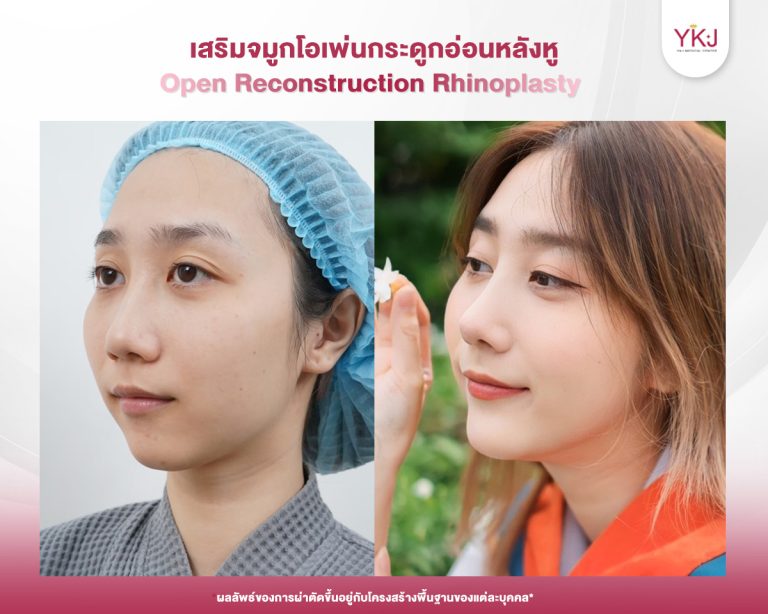 รีวิวแก้จมูก , รีวิวเสริมจมูกโอเพ่น , กระดูกอ่อนหลังหู