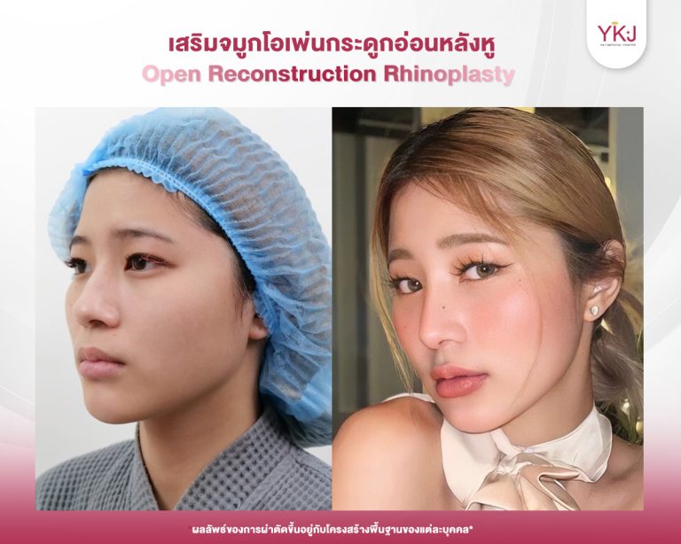 รีวิวแก้จมูก , รีวิวเสริมจมูกโอเพ่น , กระดูกอ่อนหลังหู