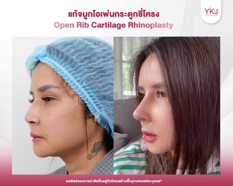 รีวิวแก้จมูก , รีวิวเสริมจมูกโอเพ่น , กระดูกซี่โครง