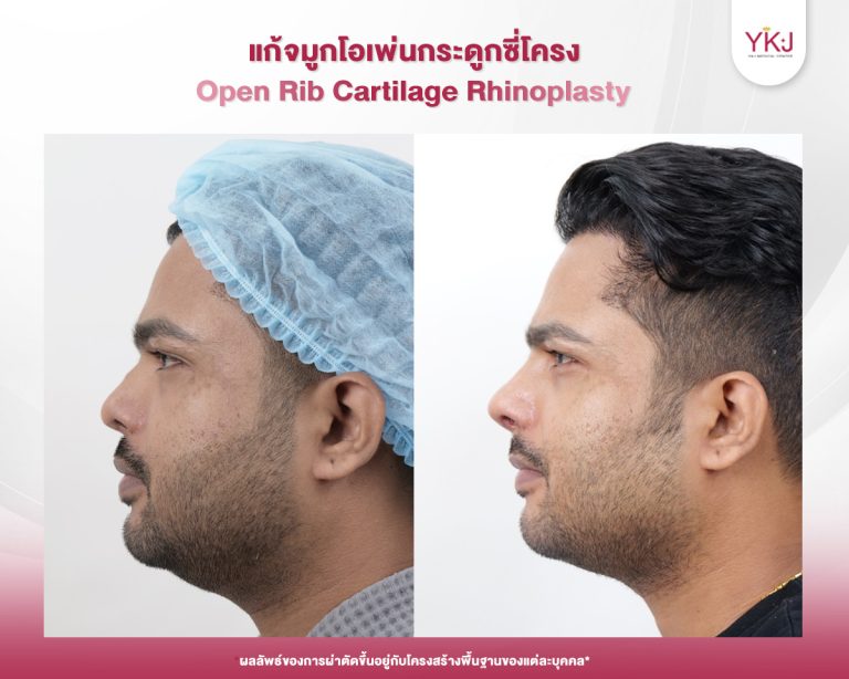 รีวิวแก้จมูก , รีวิวเสริมจมูกโอเพ่น , กระดูกซี่โครง