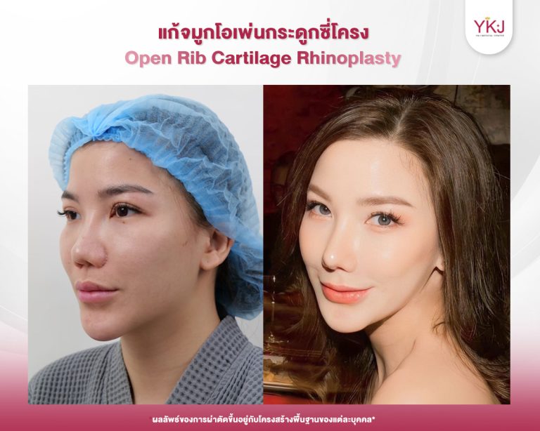 รีวิวแก้จมูก , รีวิวเสริมจมูกโอเพ่น , กระดูกซี่โครง