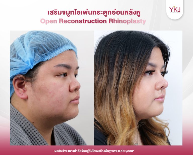รีวิวแก้จมูก , รีวิวเสริมจมูกโอเพ่น , กระดูกอ่อนหลังหู