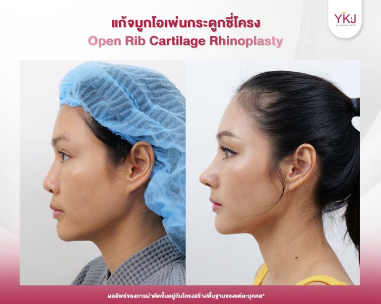รีวิวแก้จมูก , รีวิวเสริมจมูกโอเพ่น , กระดูกซี่โครง