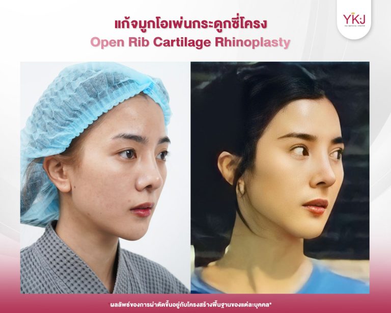 รีวิวแก้จมูก , รีวิวเสริมจมูกโอเพ่น , กระดูกซี่โครง