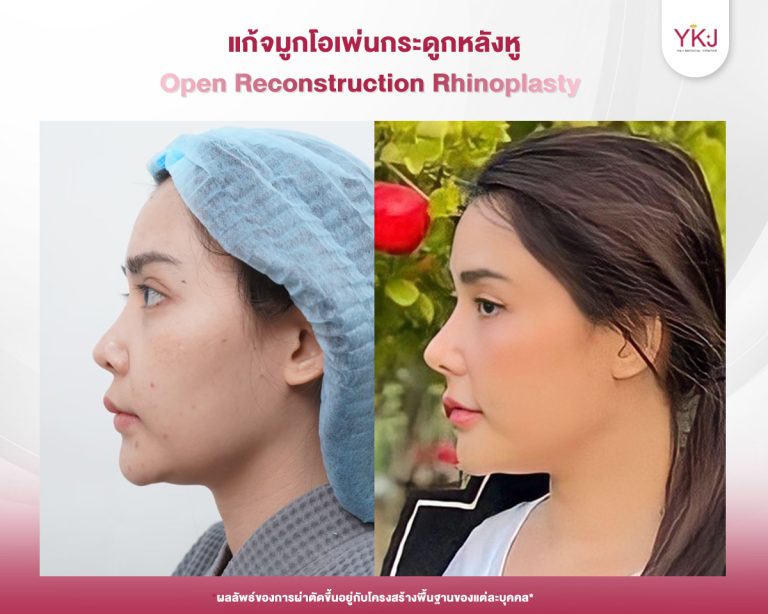 รีวิวแก้จมูก , รีวิวเสริมจมูกโอเพ่น , กระดูกอ่อนหลังหู