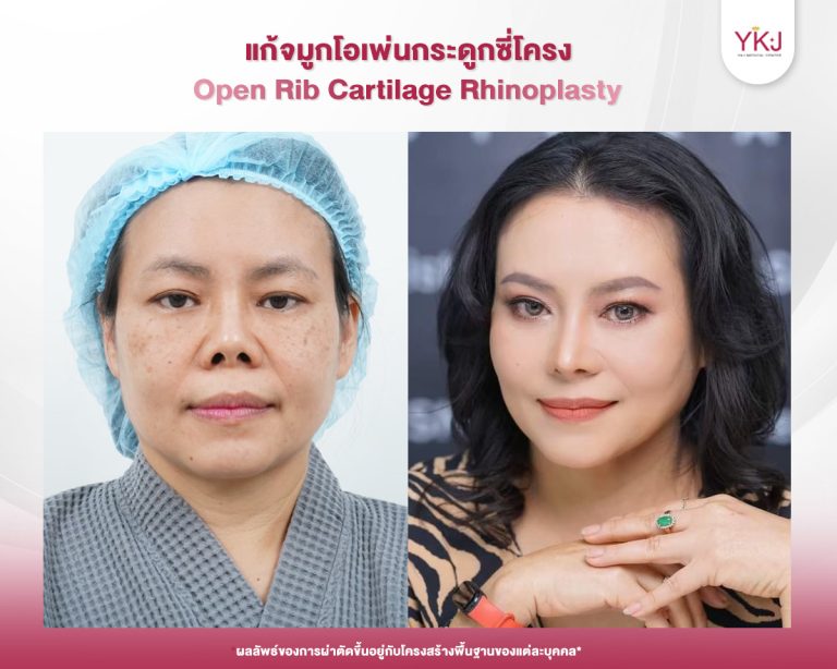 รีวิวแก้จมูก , รีวิวเสริมจมูกโอเพ่น , กระดูกซี่โครง