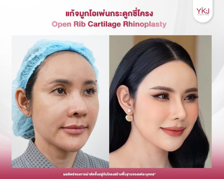 รีวิวแก้จมูก , รีวิวเสริมจมูกโอเพ่น , กระดูกซี่โครง