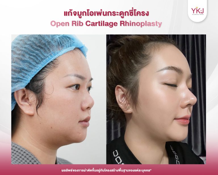 รีวิวแก้จมูก , รีวิวเสริมจมูกโอเพ่น , กระดูกซี่โครง