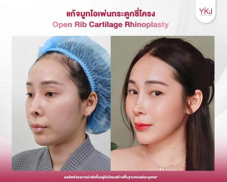 รีวิวแก้จมูก , รีวิวเสริมจมูกโอเพ่น , กระดูกซี่โครง