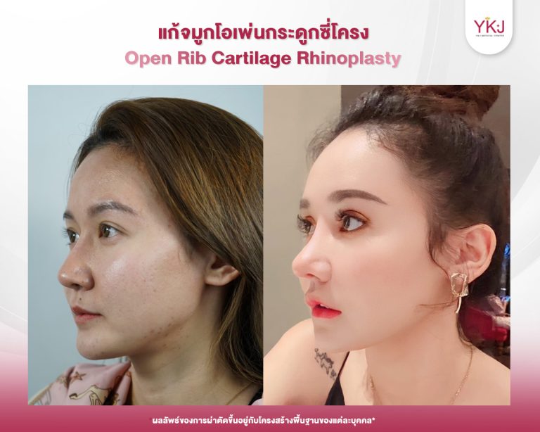 รีวิวแก้จมูก , รีวิวเสริมจมูกโอเพ่น , กระดูกซี่โครง