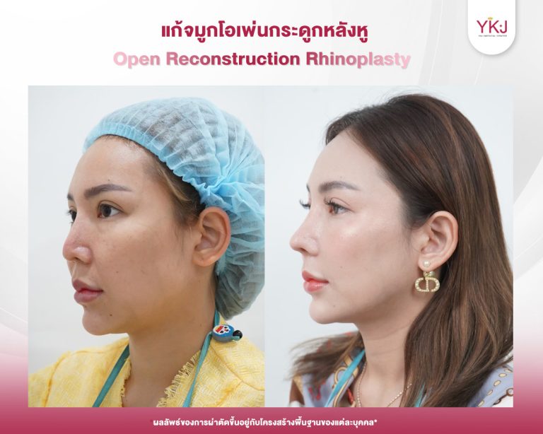 รีวิวแก้จมูก , รีวิวเสริมจมูกโอเพ่น , กระดูกอ่อนหลังหู