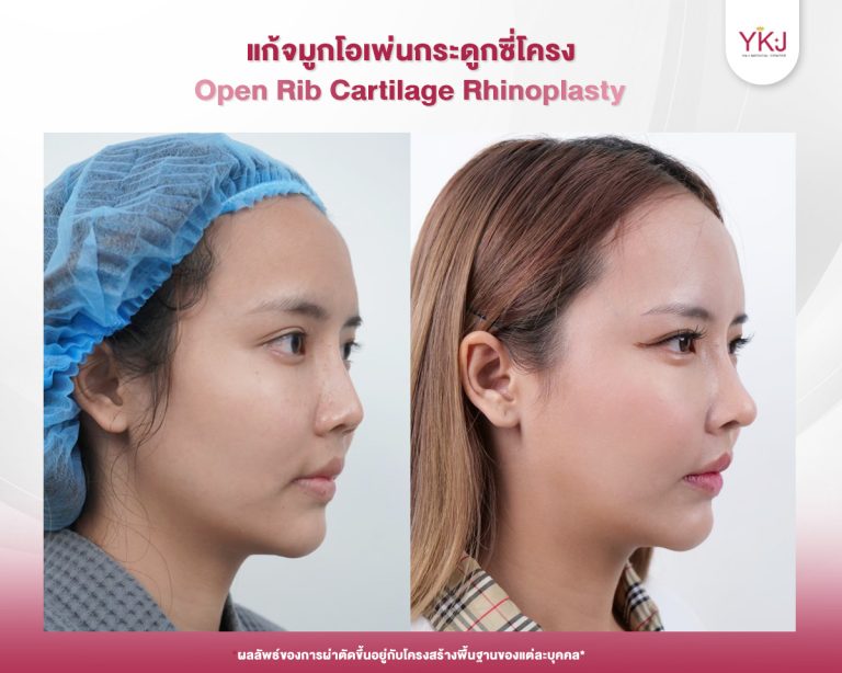 รีวิวแก้จมูก , รีวิวเสริมจมูกโอเพ่น , กระดูกซี่โครง