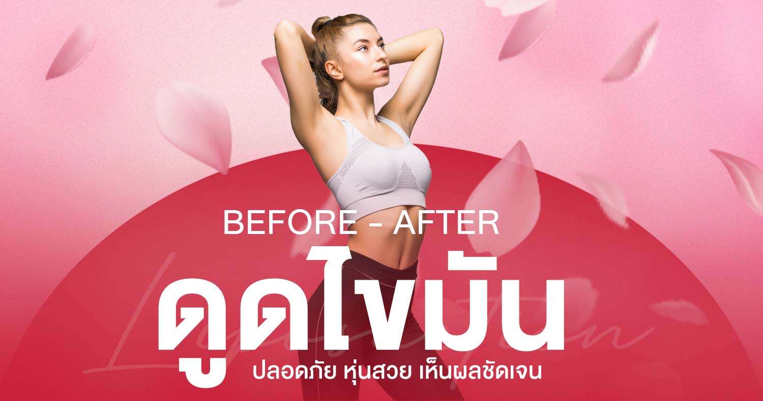 ดูดไขมัน-Before-After