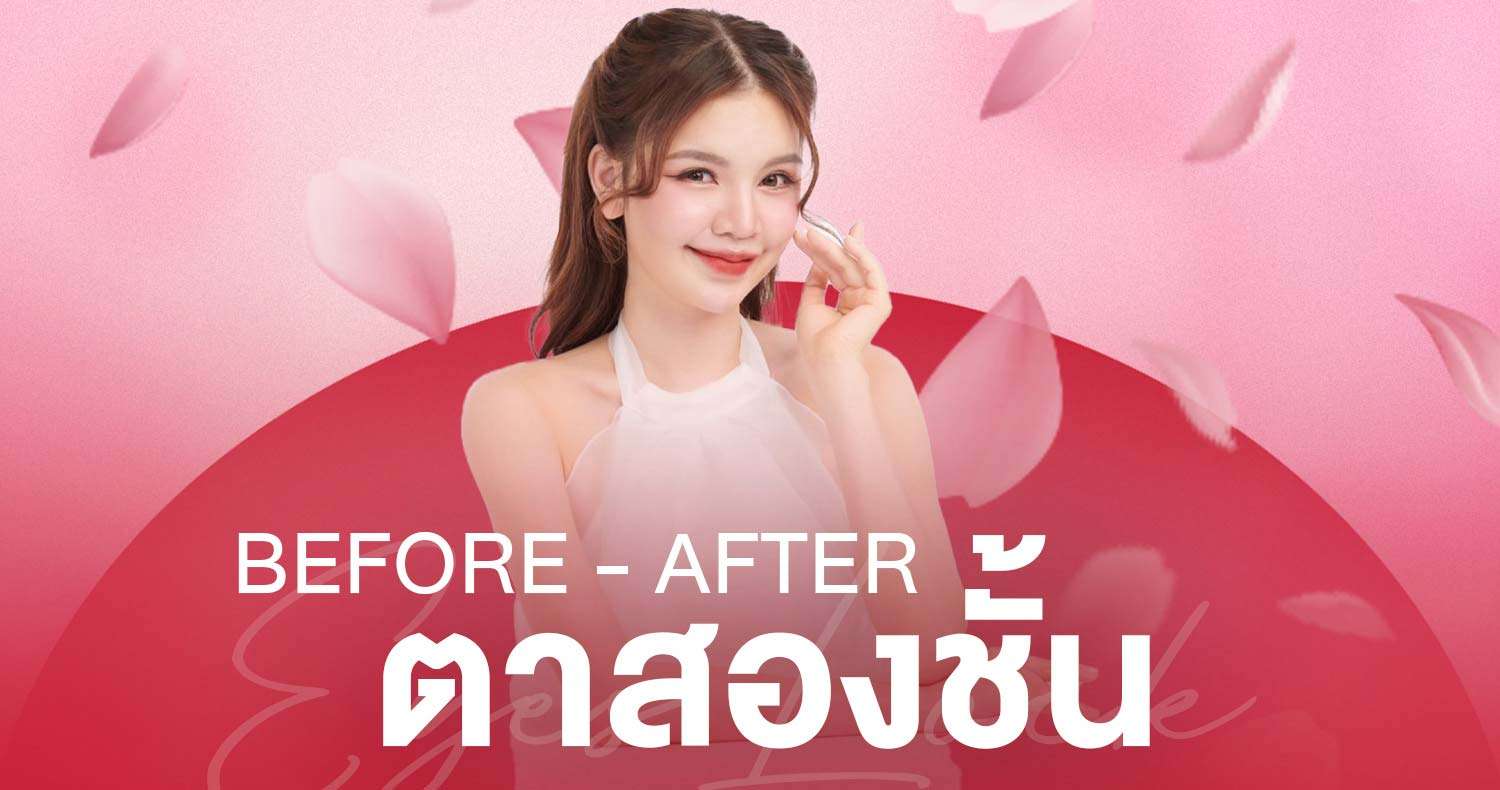 ภาพก่อนหลังทำตาสองชั้น , ภาพก่อนหลังแก้ตาสองชั้น