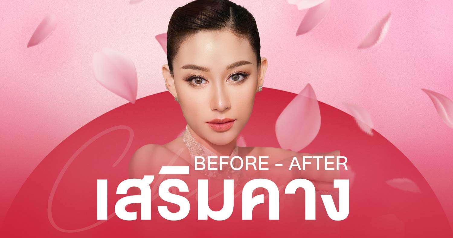 ภาพก่อนหลังเสริมคาง