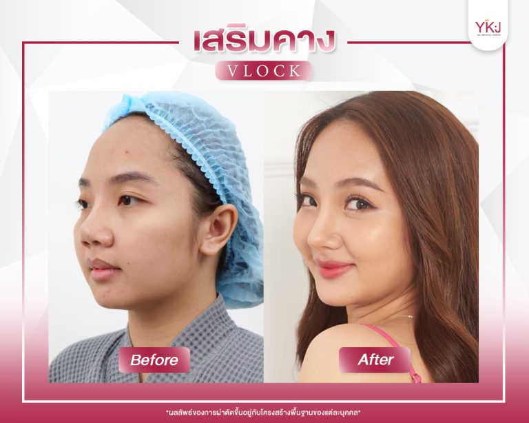 ภาพก่อนหลังเสริมคาง