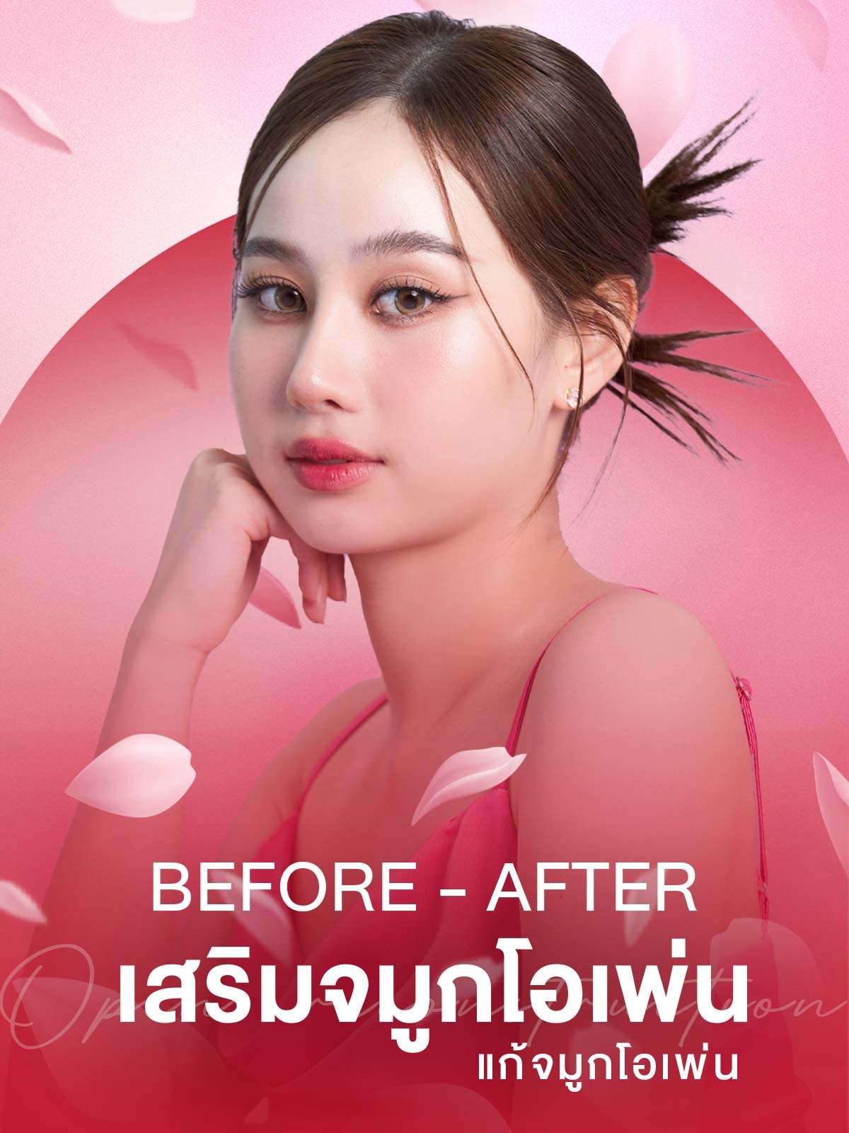 ภาพก่อนหลังศัลยกรรมจมูก , ภาพก่อนหลังแก้จมูกโอเพ่น