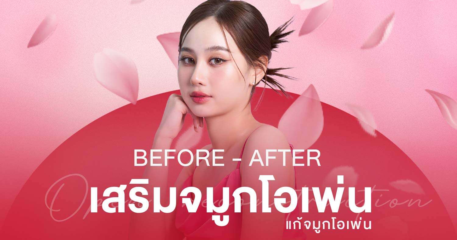 ภาพก่อนหลังศัลยกรรมจมูก , ภาพก่อนหลังแก้จมูกโอเพ่น