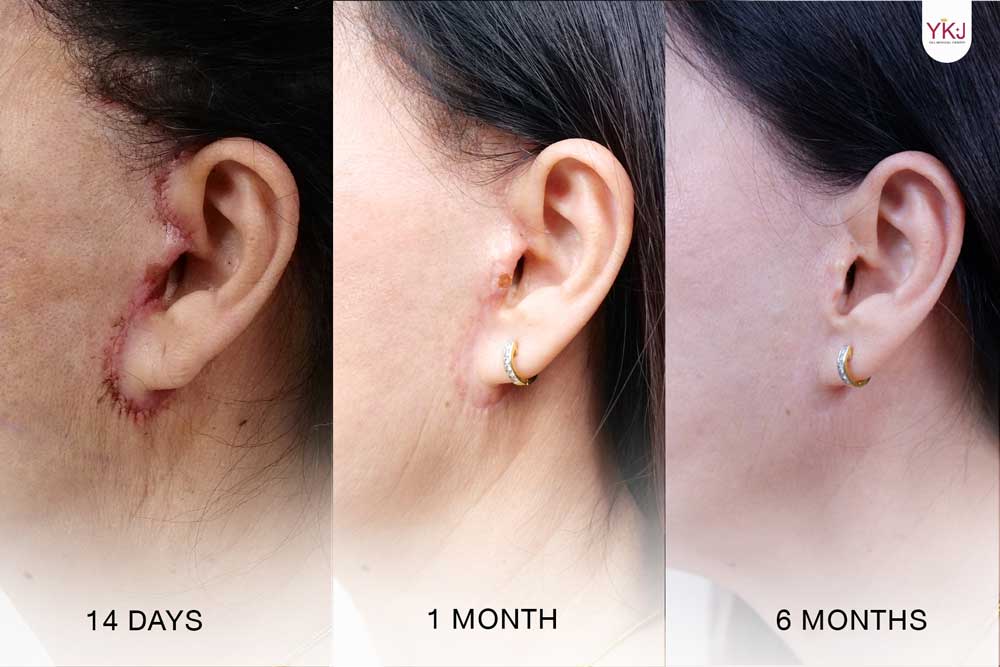 facelift scar