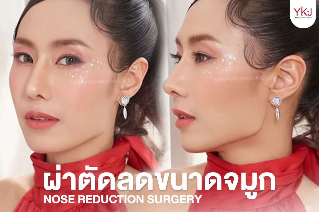 ผ่าตัดลดขนาดจมูก , nose-reduction-surgery