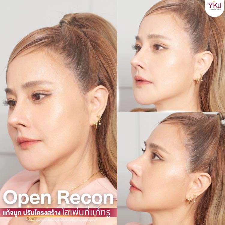 แก้จมูก-โอเพ่นซี่โครง-ribcartilage-009