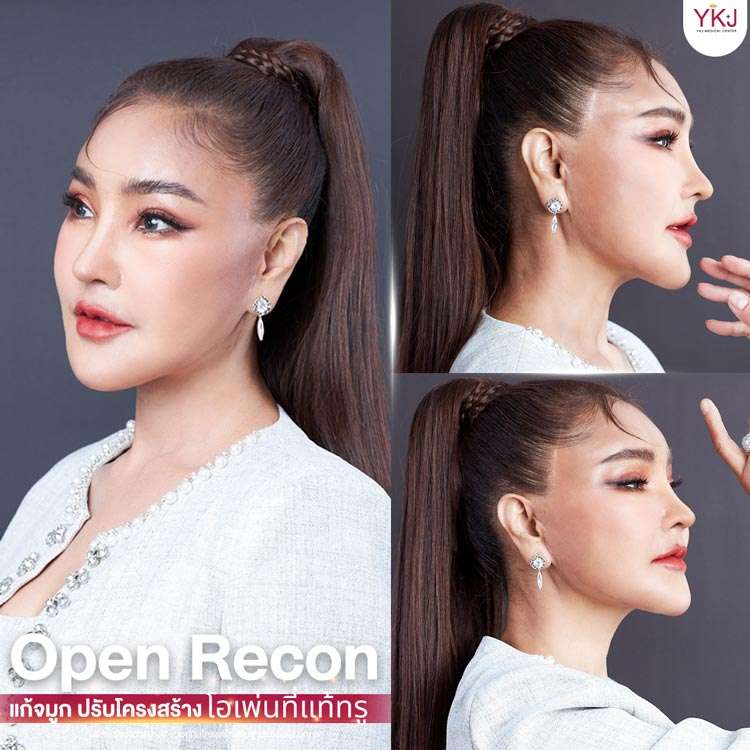 แก้จมูก-โอเพ่นซี่โครง-ribcartilage-020