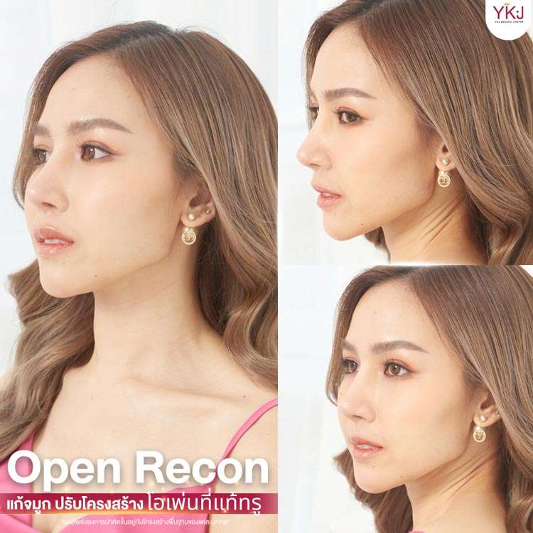 แก้จมูก-โอเพ่นซี่โครง-ribcartilage-025