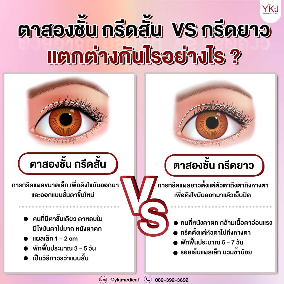 ตาสองชั้น กรีดสั้น กรีดยาว ต่างกันอย่างไร