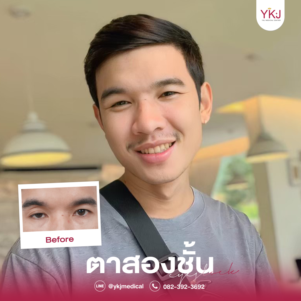 ชั้นตาไม่เท่ากัน