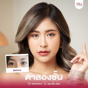 ก่อนหลังตาสองชั้น