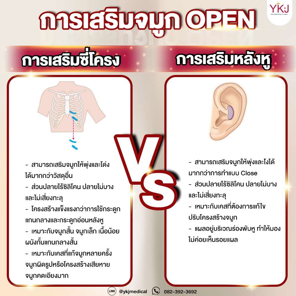 เสริมจมูกซี่โครง-หลังหู ต่างกันอย่างไร