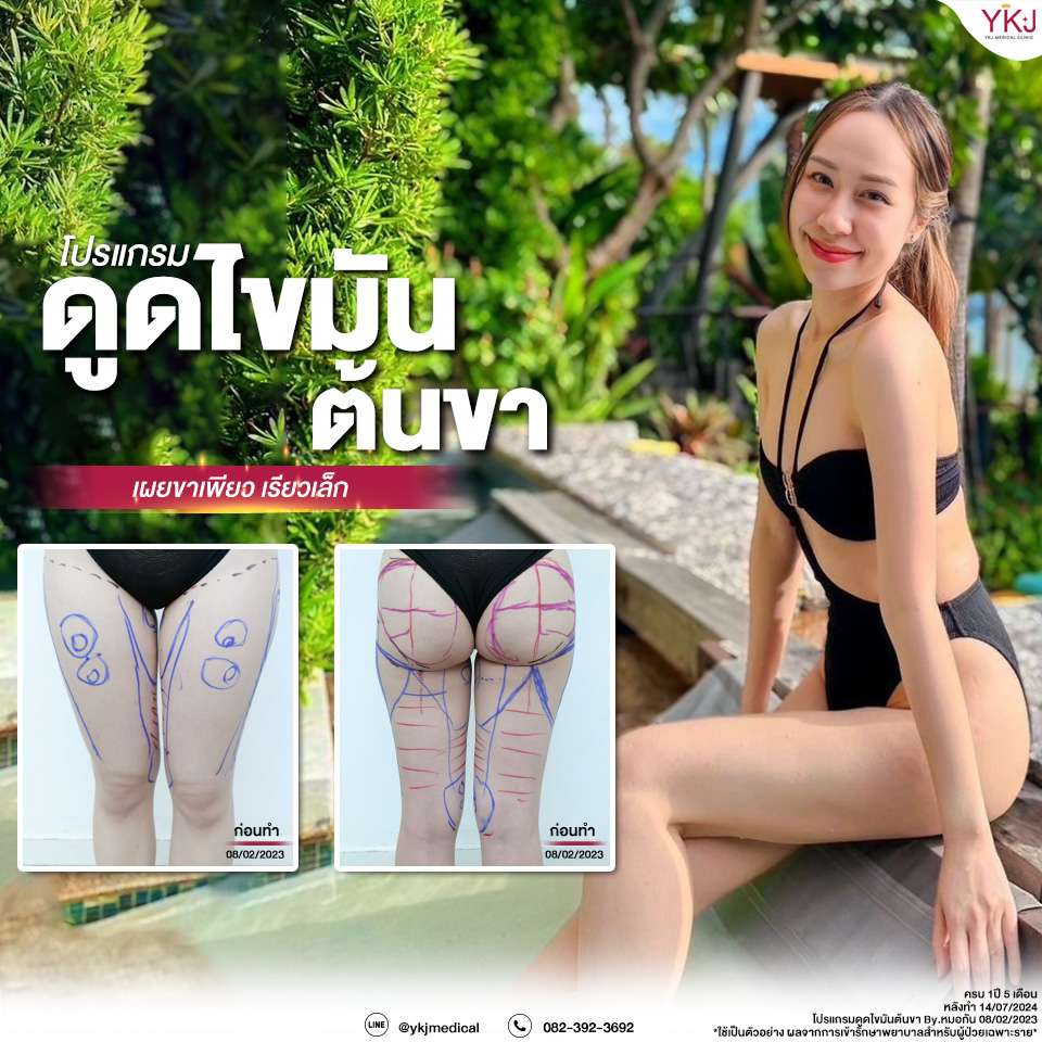 ดูดไขมัน , รูปร่างลีน , Liposuction