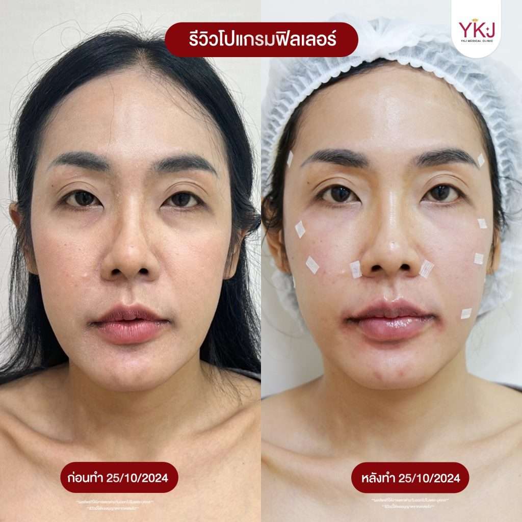 ฟิลเลอร์-filler