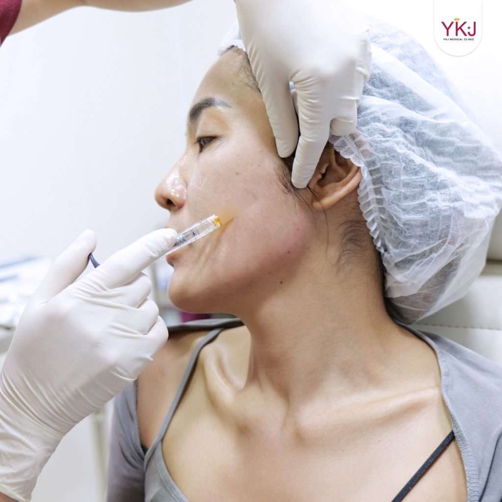 ฟิลเลอร์-filler