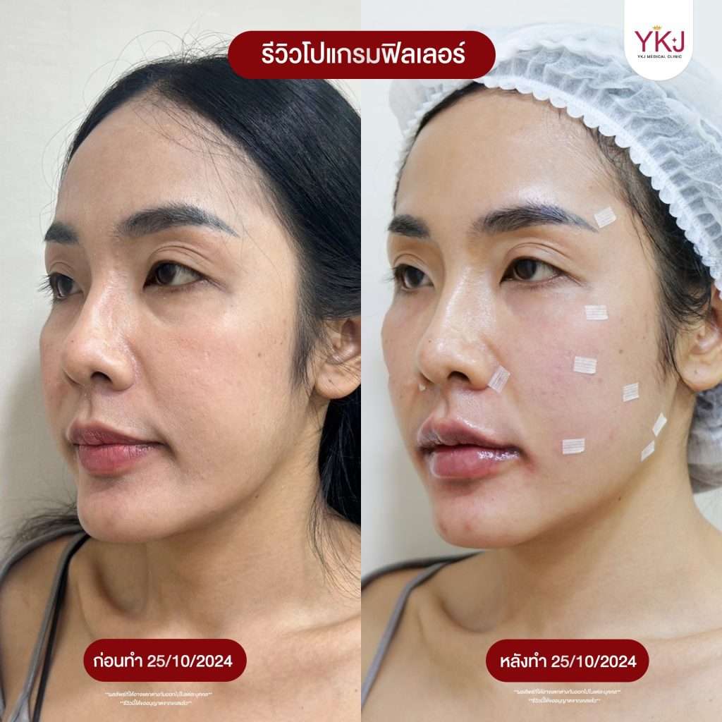 ฟิลเลอร์-filler