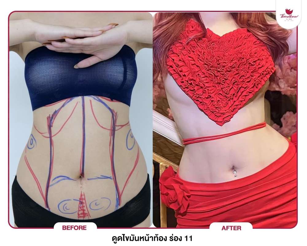 ดูดไขมัน , รูปร่างลีน , Liposuction