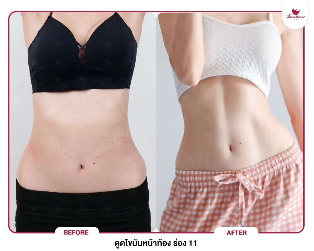ดูดไขมัน , รูปร่างลีน , Liposuction