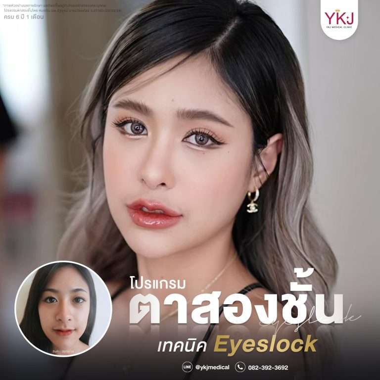 รีวิวตาสองชั้น , รีวิวแก้ตาสองชั้น, ทำตาสองชั้น