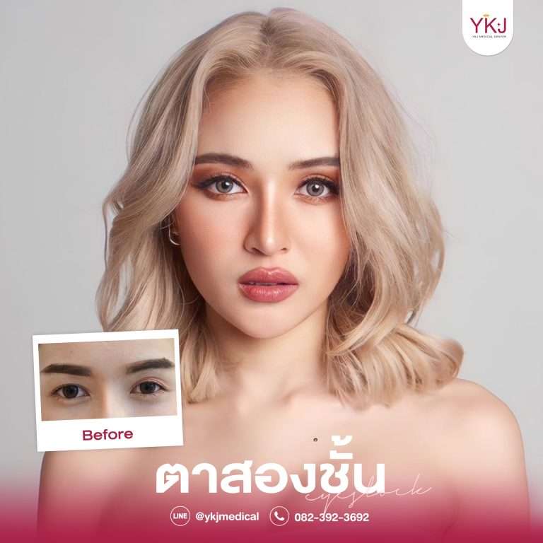 รีวิวตาสองชั้น , รีวิวแก้ตาสองชั้น, ทำตาสองชั้น
