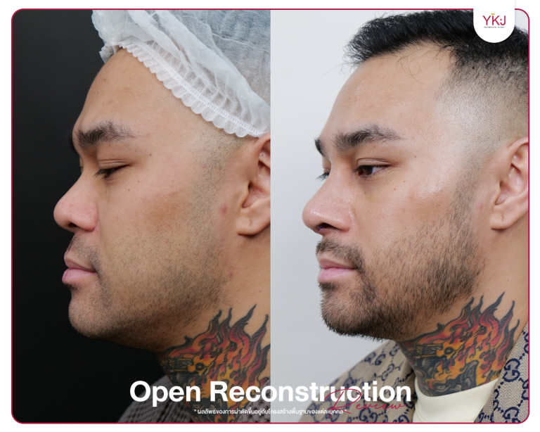 รีวิวแก้จมูก , รีวิวเสริมจมูกโอเพ่น , กระดูกซี่โครง , กระดูกอ่อนหลังหู