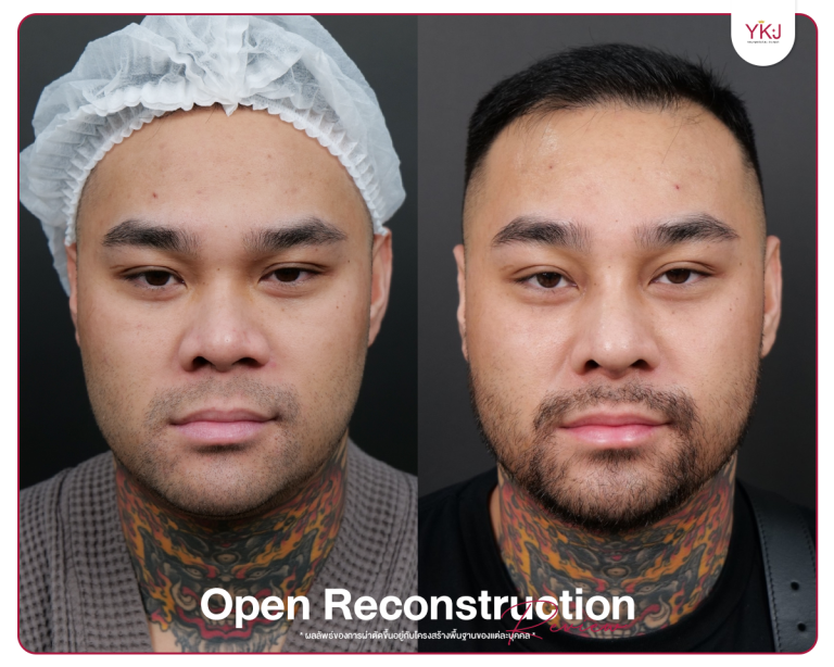 รีวิวแก้จมูก , รีวิวเสริมจมูกโอเพ่น , กระดูกซี่โครง , กระดูกอ่อนหลังหู