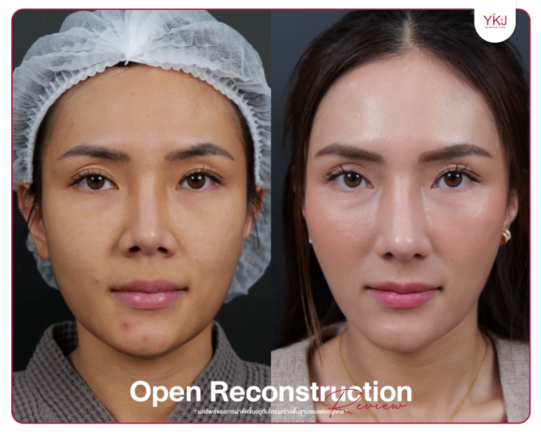 รีวิวแก้จมูก , รีวิวเสริมจมูกโอเพ่น , กระดูกซี่โครง , กระดูกอ่อนหลังหู