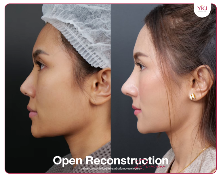 รีวิวแก้จมูก , รีวิวเสริมจมูกโอเพ่น , กระดูกซี่โครง , กระดูกอ่อนหลังหู