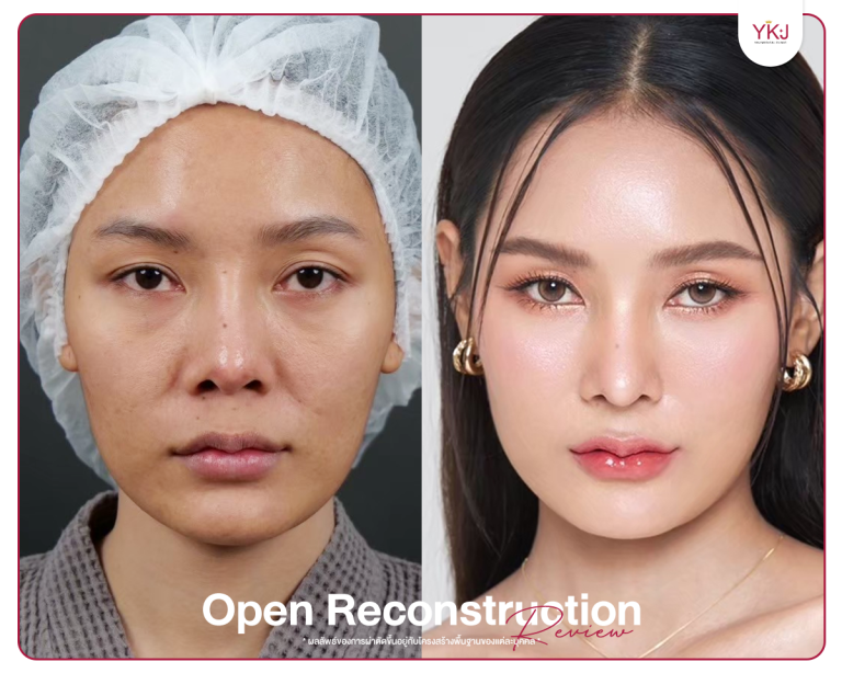 รีวิวแก้จมูก , รีวิวเสริมจมูกโอเพ่น , กระดูกซี่โครง , กระดูกอ่อนหลังหู