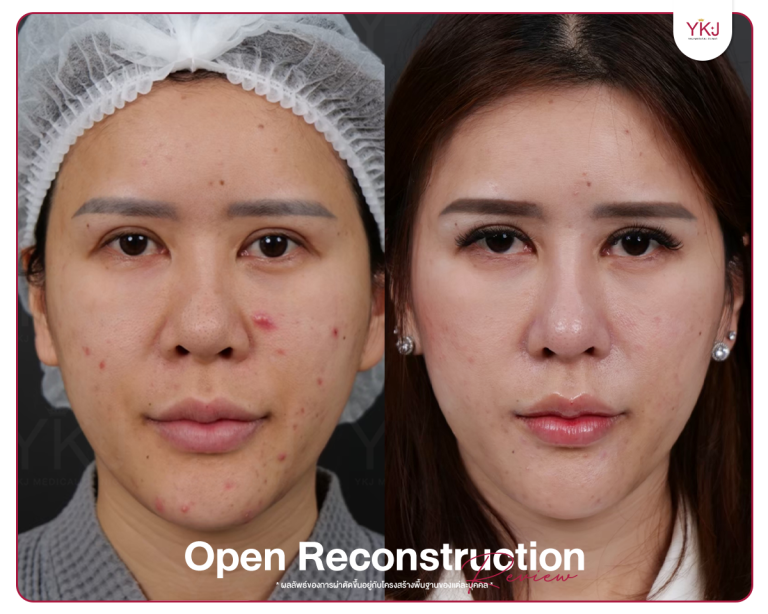 รีวิวแก้จมูก , รีวิวเสริมจมูกโอเพ่น , กระดูกซี่โครง , กระดูกอ่อนหลังหู