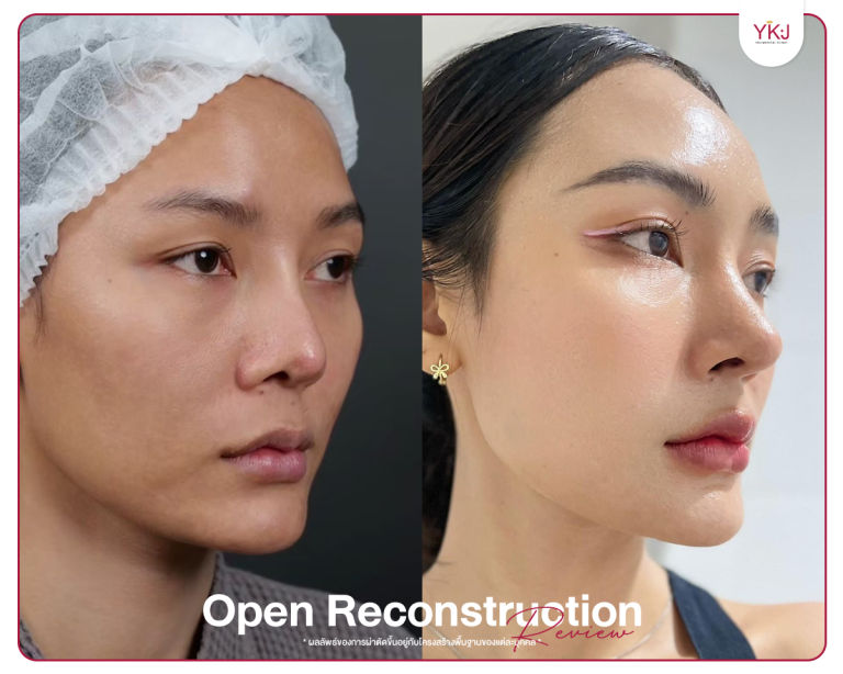 รีวิวแก้จมูก , รีวิวเสริมจมูกโอเพ่น , กระดูกซี่โครง , กระดูกอ่อนหลังหู